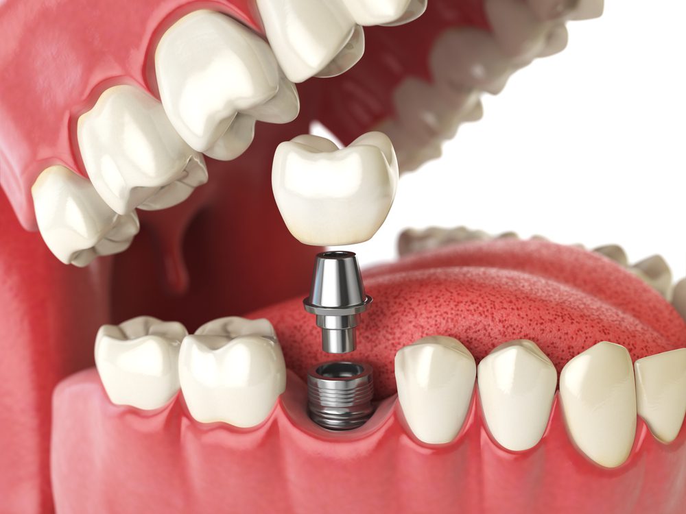 what are dental implants implant Prevention Dental Dentist in Boise Idaho