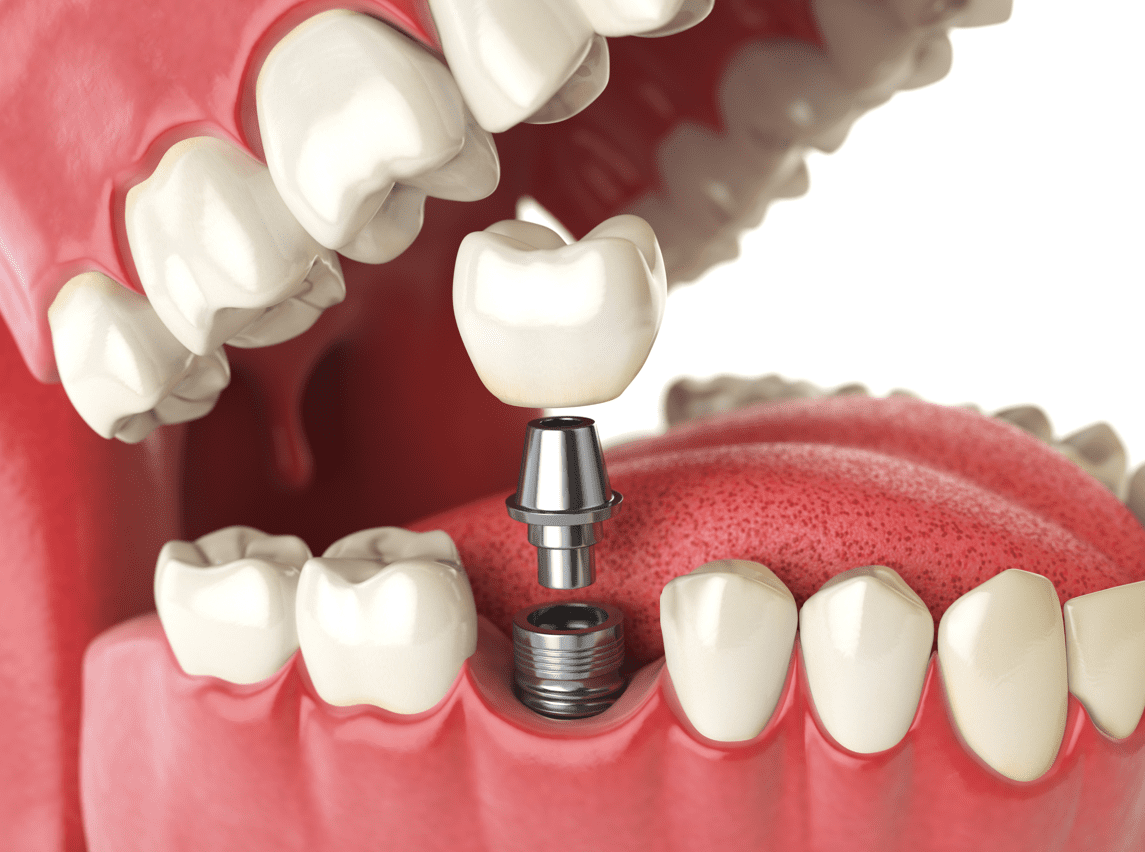 dental implants Prevention Dental Dentist in Boise Idaho