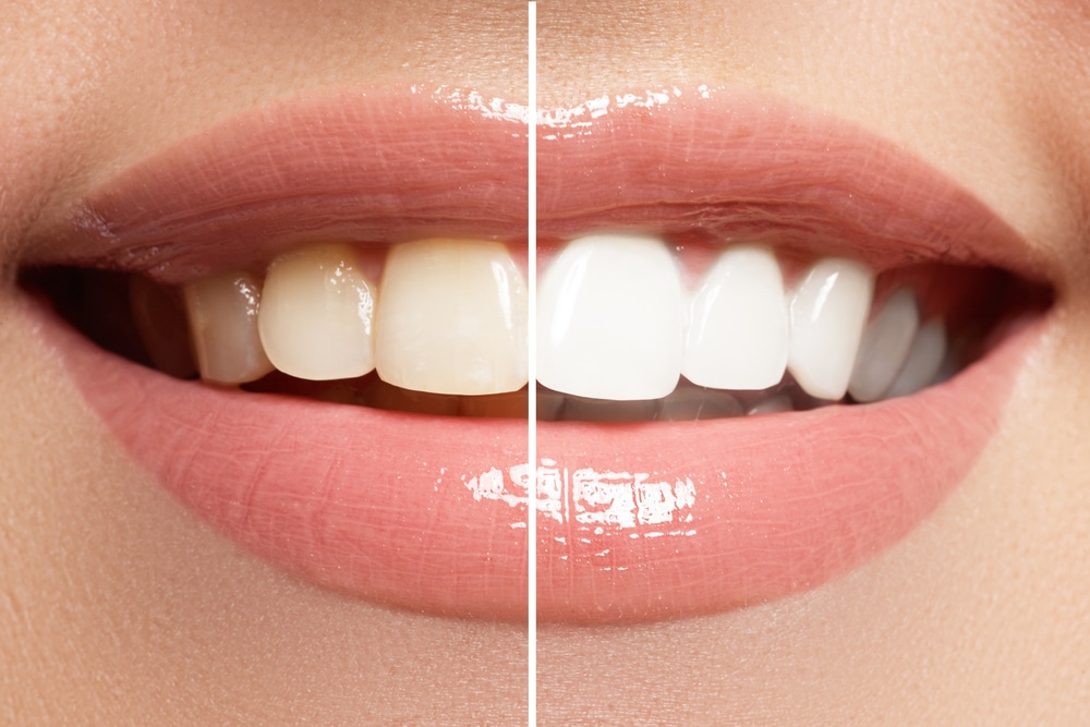 teeth whitening boise